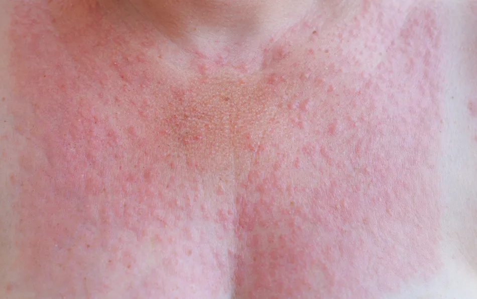 Viele rote kleine Pusteln im Dekolletébereich