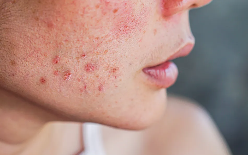 Nahaufnahme von offenen Stellen im Gesicht