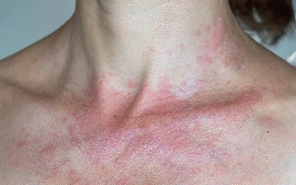 Rote Flecken im Dekolletébereich mit Quaddelbildung am Hals