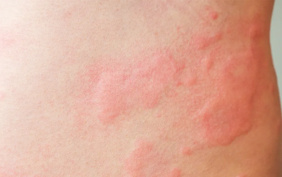 Rötliche geschwollene Hautbereiche