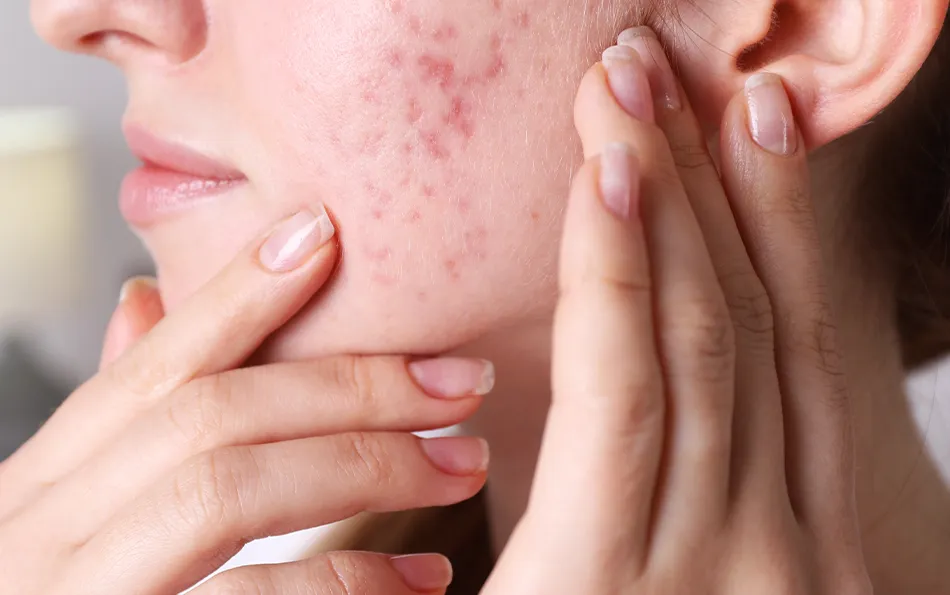 Akneflecken mit leichten Vertiefungen im Gesicht einer weiblichen Person