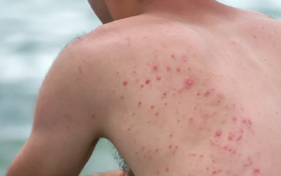 Rötliche Pusteln im Schulterblattbereich einer männlichen Person