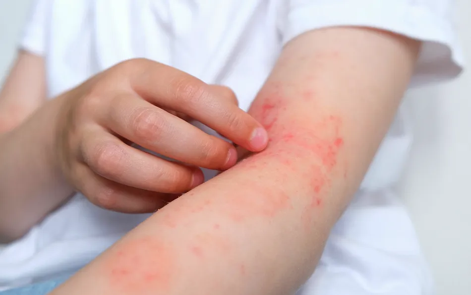 Eine Person kratzt sich an offenen Stellen am Unteraram und Beuge