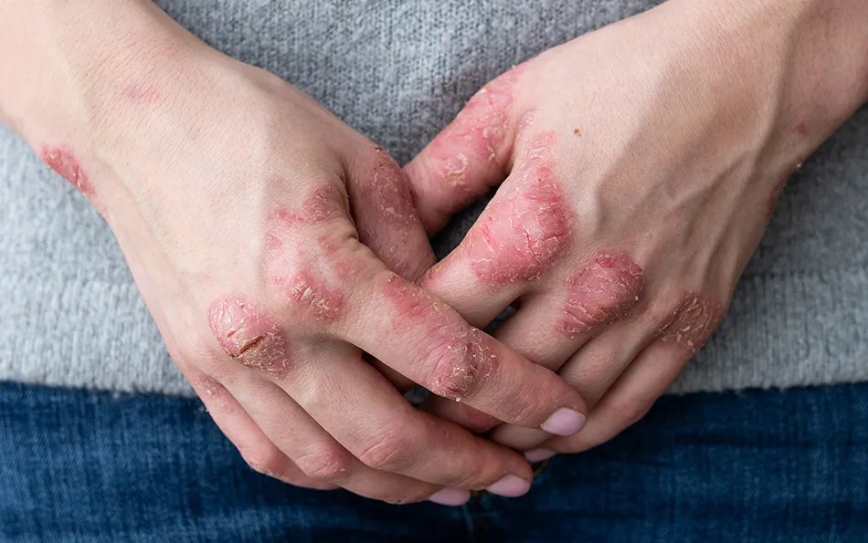 Offene Ekzeme an den Fingergelenken im Handrückenbreich, sowie Handgelenk