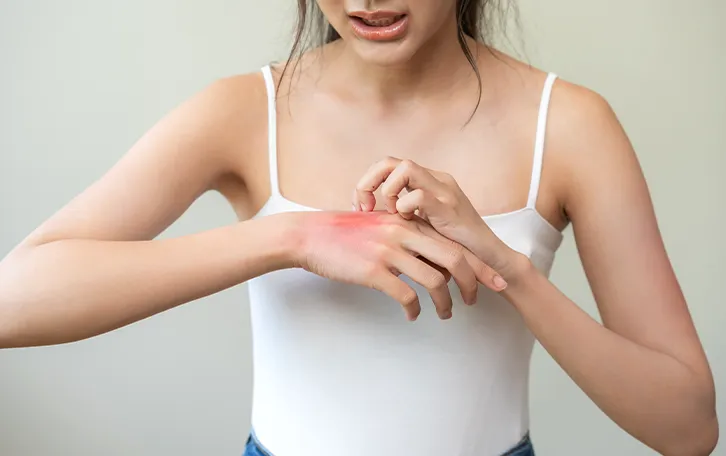 Allergie und Ekzem Hautausschlag Entzündungen Eine weibliche Person kratzt sich auf ihrem geröteten Handrücken mit den Fingernägeln