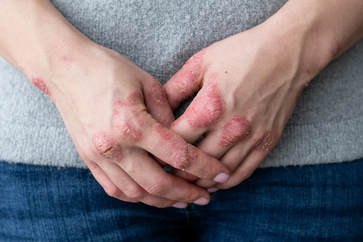 Offene Ekzeme an den Fingergelenken im Handrückenbreich, sowie Handgelenk