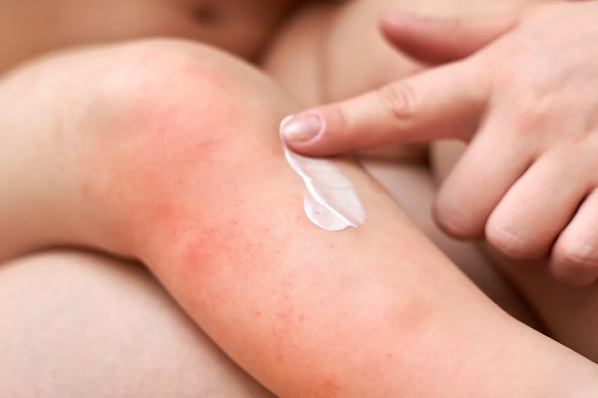 Creme wird mit einem Finger auf einer geröteten Hautpartie verteilt