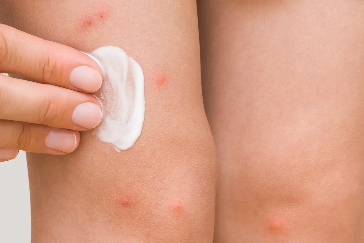 Nahaufnahme von Creme die auf roten Pusteln auf der Haut von Fingern im Armbereich aufgetragen wird