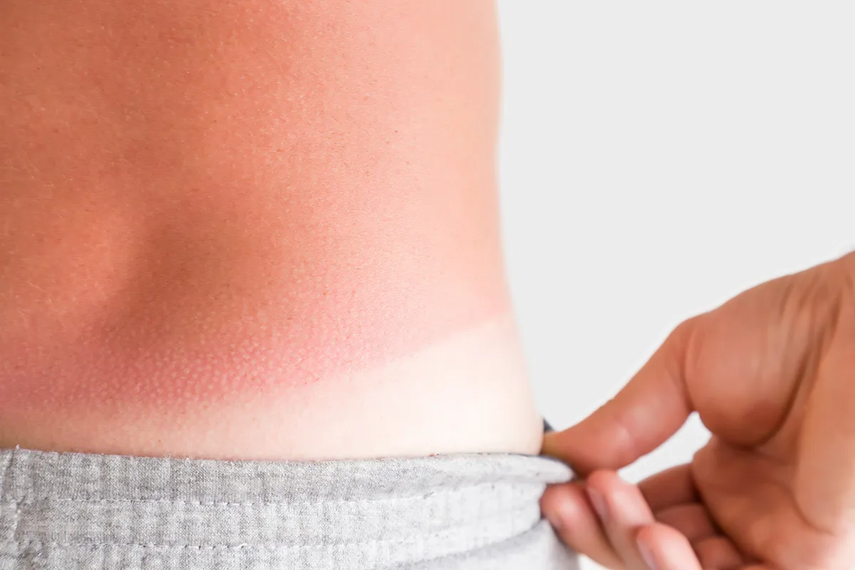 Nahaufnahme vom Hüftbereich, wo man den Unterscheid zur bedeckten Haut in weiß und einem starken Sonnenbrand auf dem Rücken erkennen kann, da eine Hand den Hosenbund leicht bei seite zieht