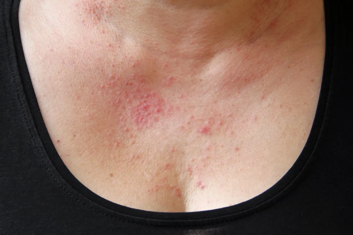 Viele rötliche Pusteln im Dekolletébereich