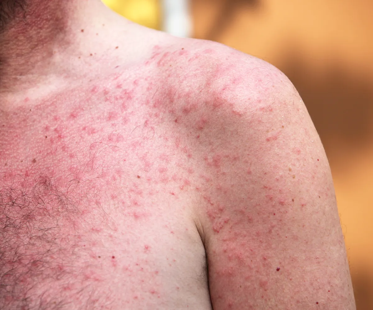 Viele rötliche Pusteln im Brust-, Schulter- und Armbreich einer männlichen Person