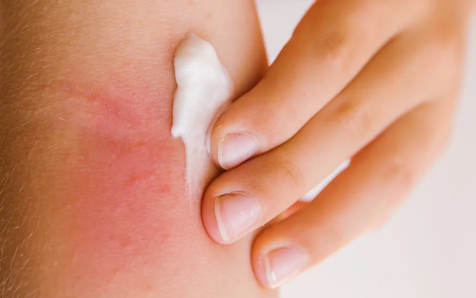 Creme bei Juckreiz Nahaufnahme von Creme die auf einer großeren roten Hautpartie von Fingern aufgetragen wird