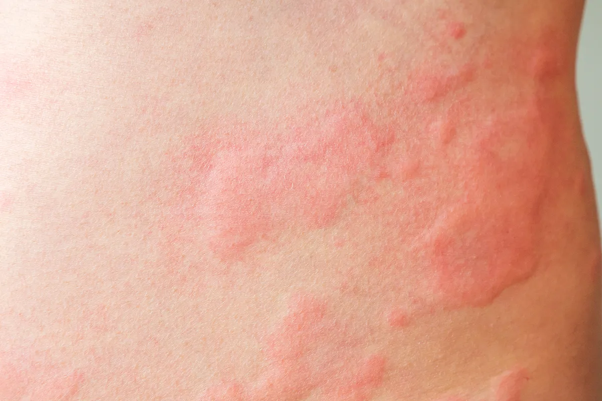 Rötliche geschwollene Hautbereiche