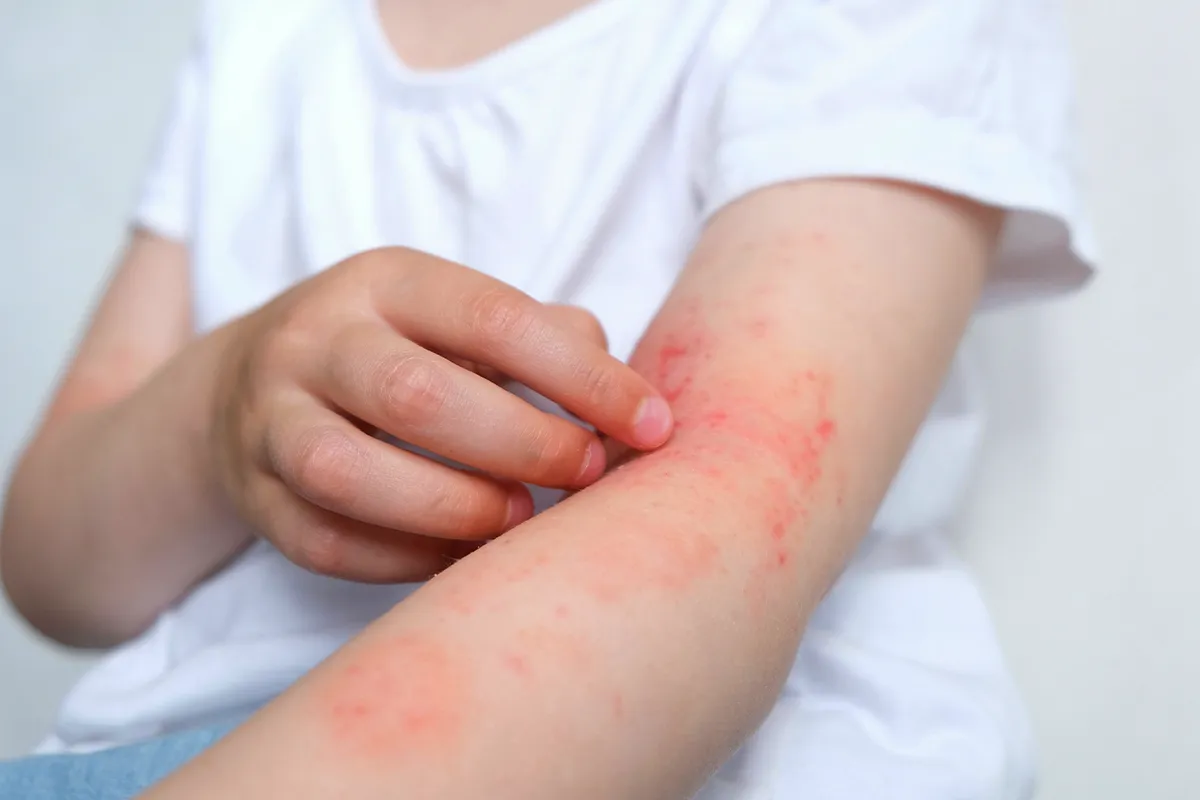 Eine Person kratzt sich an offenen Stellen am Unteraram und Beuge