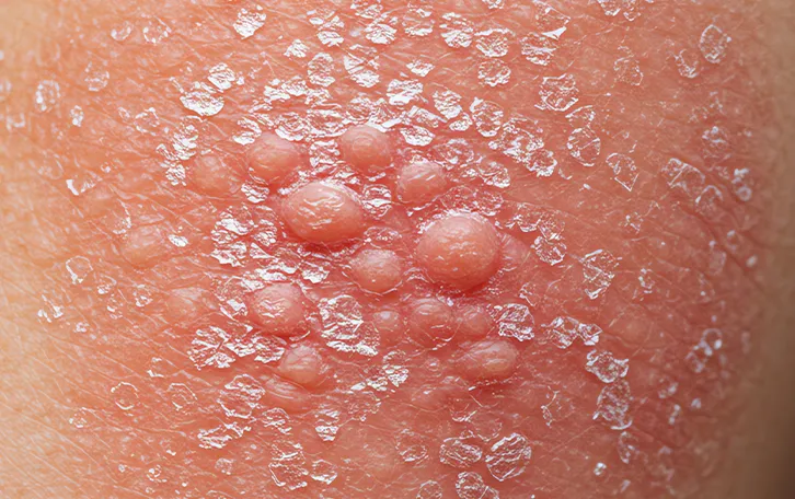 Sehr starker Sonnenbrand mit Blasenbildung