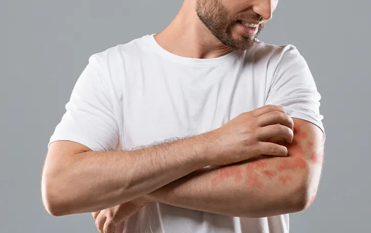 Ein männlich Person mit großen Ekztemen am linken Ober- und Unterarm