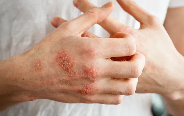 Großflächige offene Stellen mit Krust auf den Handrücken und eine Hand kratz die andere