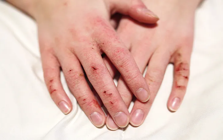 Rissige Haut an den Gelenken der Finger