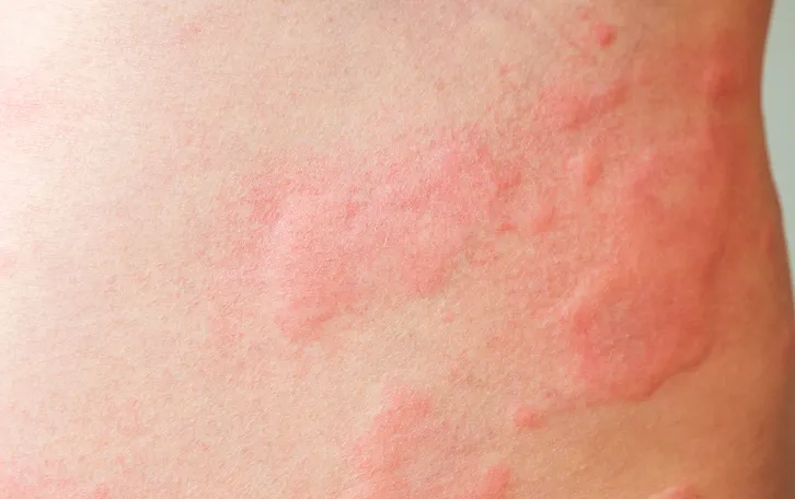 Rötliche geschwollene Hautbereiche