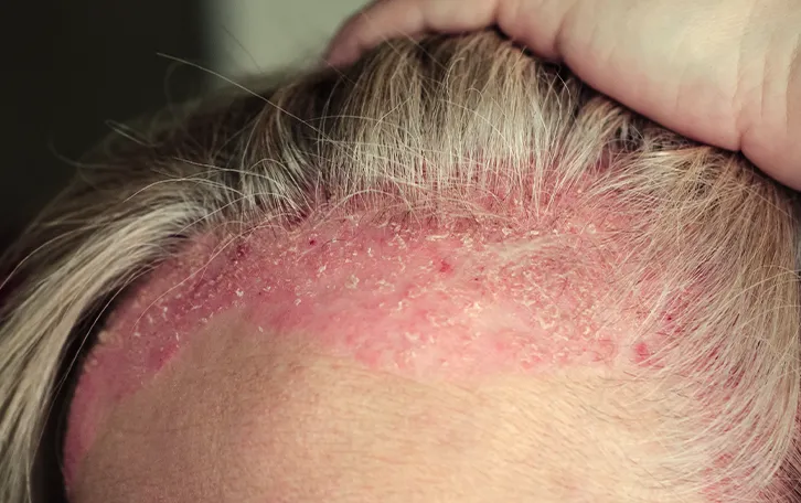 Schuppige Haut im Haaransatzbereich