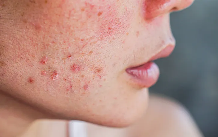 Hautausschlag Arten Akne Nahaufnahme von offenen Stellen im Gesicht