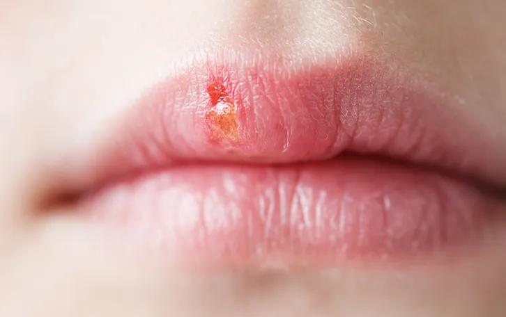 Hautausschlag Arten Herpes Nahaufnahme Herpes an einer Oberlippe