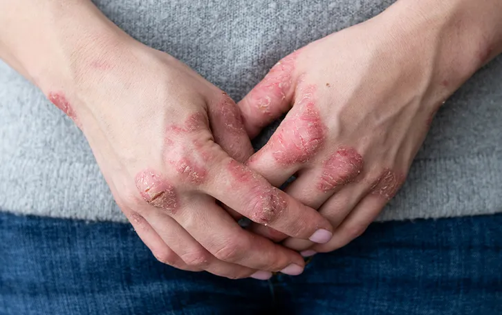 Hautausschlag Arten Kontaktdermatitis Offene Ekzeme an den Fingergelenken im Handrückenbreich, sowie Handgelenk