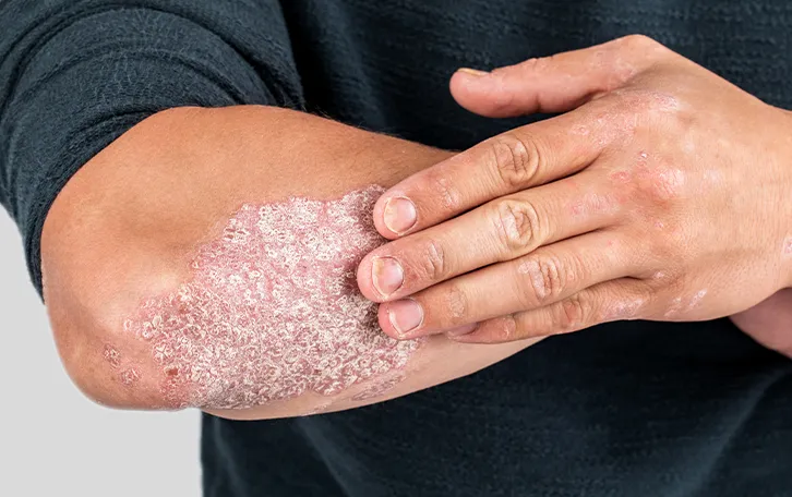 Hautausschlag Arten Psoriasis Großflächige schuppige Hautflächen am äußeren Unterarm einer männlichen Person