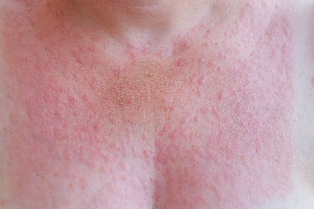 Hautausschlag effektive Behandlungsmöglichkeiten Viele rote kleine Pusteln im Dekolletébereich