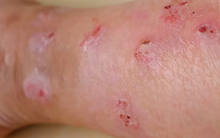 Offene rissige Pusteln auf der Haut