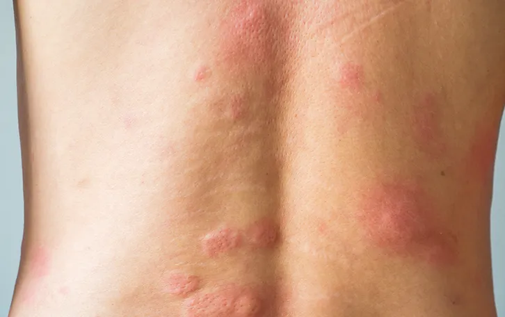 Großflächige Quaddeln am Rücken