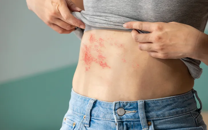 Großflächiges Ekzem im äußeren Bauchbereich mit blutigen offenen Rissen