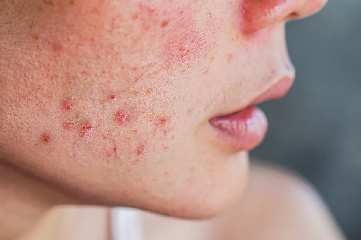 Nahaufnahme von offenen Stellen im Gesicht