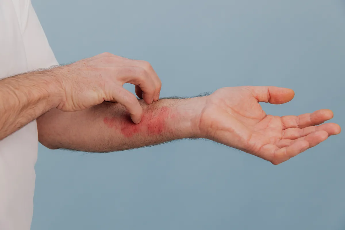 Hauterkrankungen häufige Auslöser für Hautausschlag Eine männliche Person mit starker großflächiger Rötung am inneren Unterarm, die sich mit der anderen Hand auf der Stelle kratzt