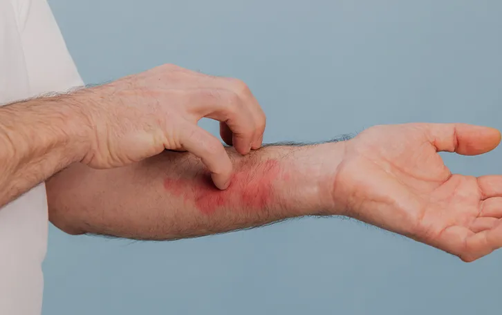 Hautrötung Ursachen Hauterkrankungen Eine männliche Person mit starker groĂŸflächiger Rötung am inneren Unterarm, die sich mit der anderen Hand auf der Stelle kratzt