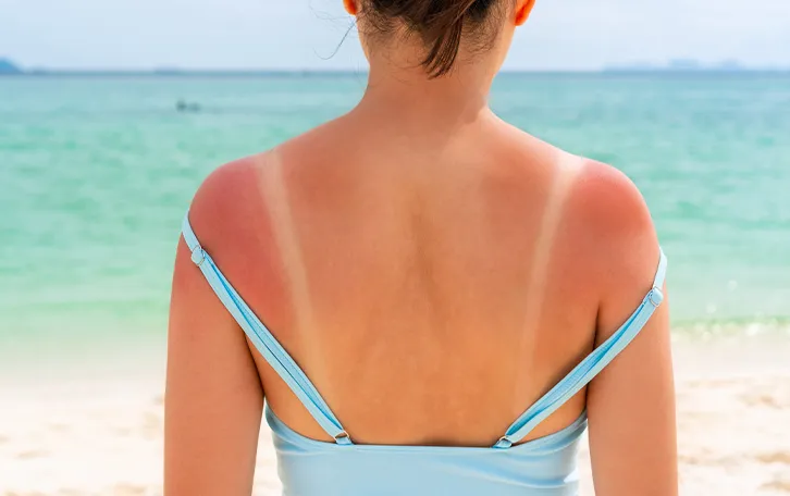 Hautroetung Ursachen Sonneneinstrahlung Starker Sonnenbrand im Schulterbereich einer weiblichen Person. Unterschied durch Trägeroberteil sehr gut erkennbar