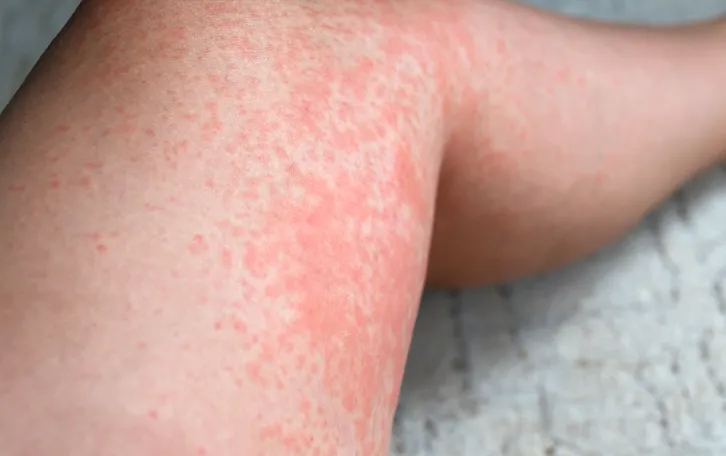 Großflächige rötliche Stelle im Kniebereich einer Person