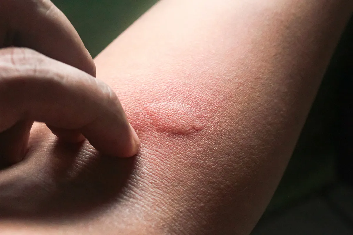 Ein dicke Quaddel mit starker Rötung drum herum