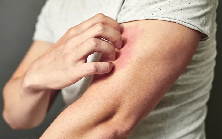 Eine männliche Person kratz sich an einer geröteten Stelle am linken Oberarm