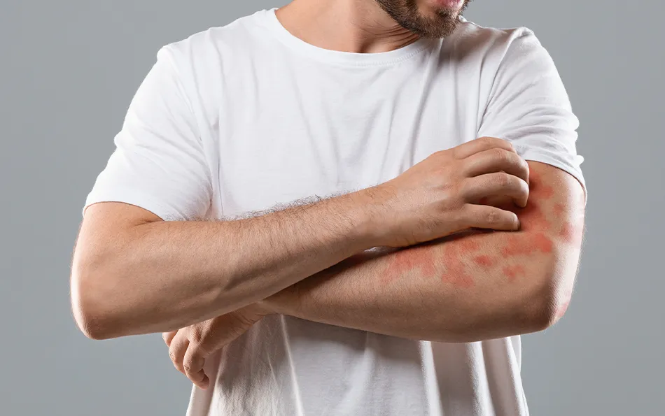 Ein männlich Person mit großen Ekztemen am linken Ober- und Unterarm