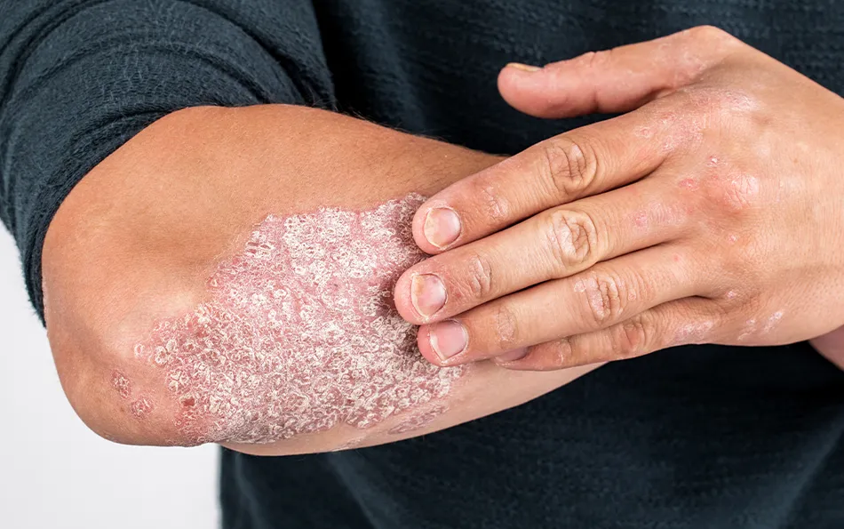 Großflächige schuppige Hautflächen am äußeren Unterarm einer männlichen Person