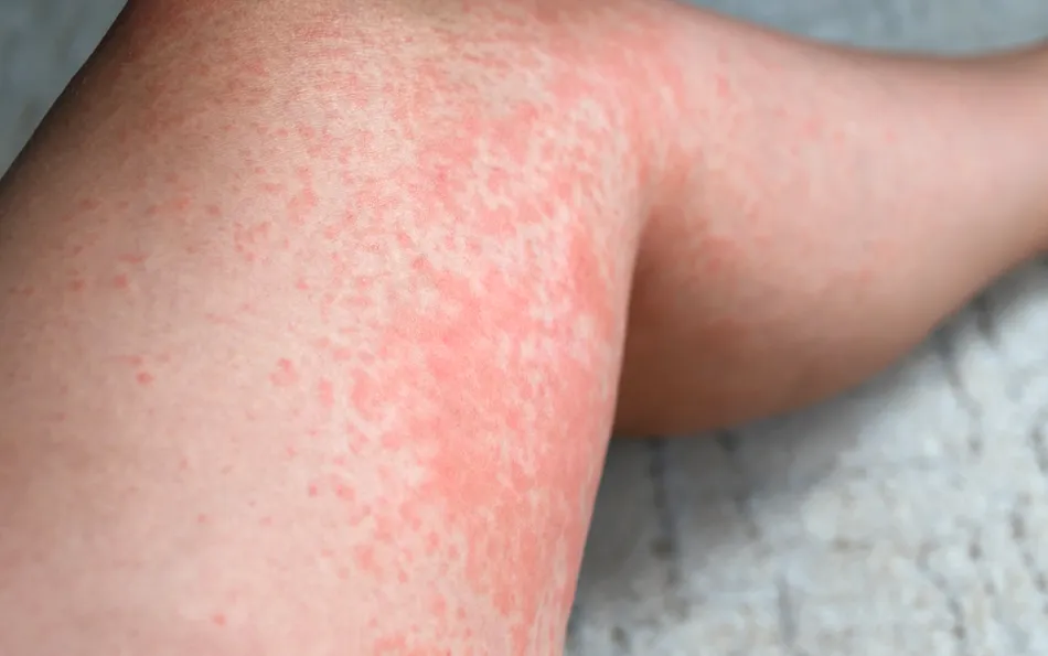 Großflächige rötliche Stelle im Kniebereich einer Person