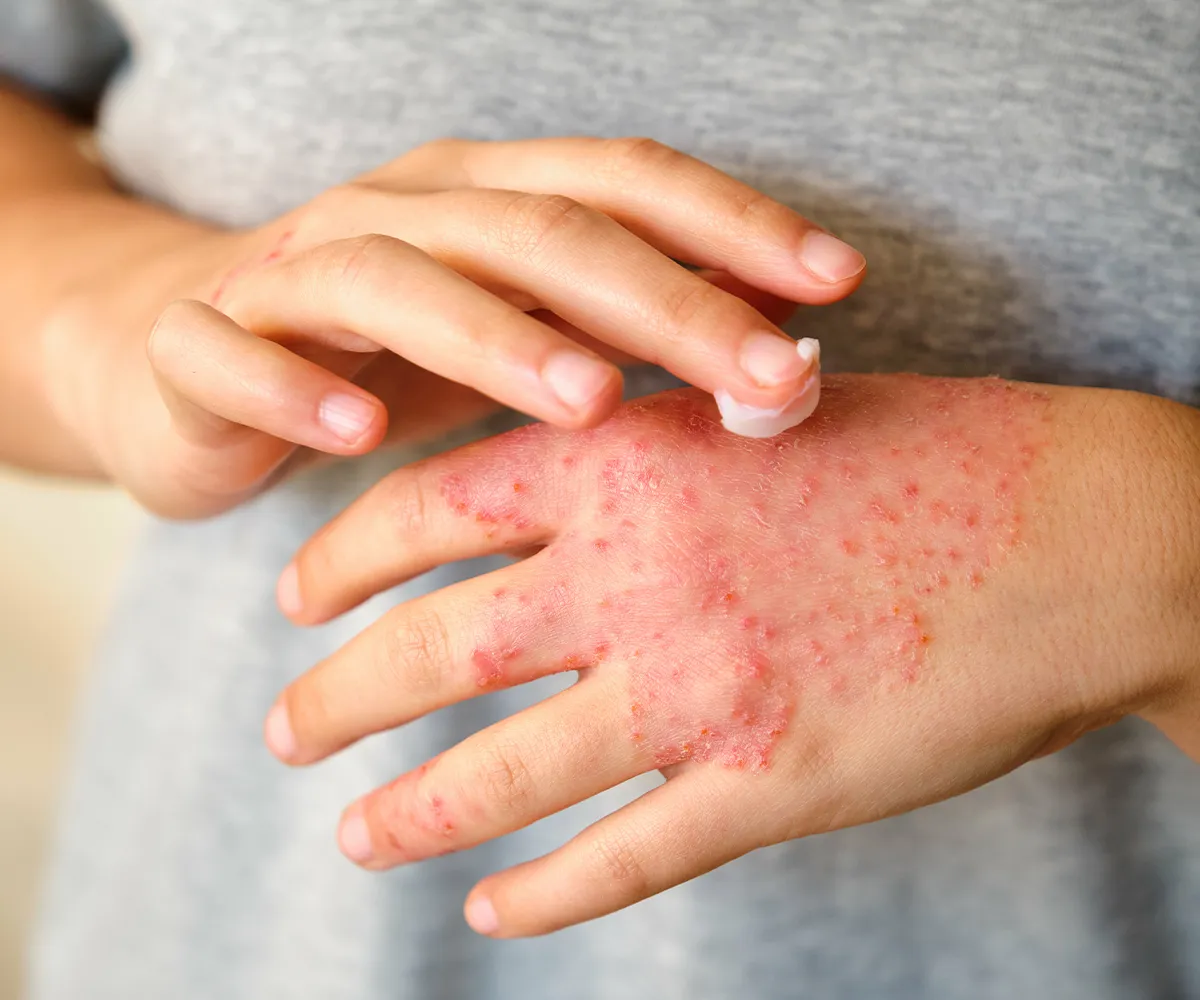 Fast der komplette Handrücken ist mit roten, teils dicken Pusteln überzogen und eine Hand setzt zum großzügigen verteilen von Creme an