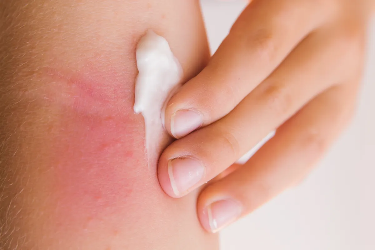 Nahaufnahme von Creme die auf einer großeren roten Hautpartie von Fingern aufgetragen wird