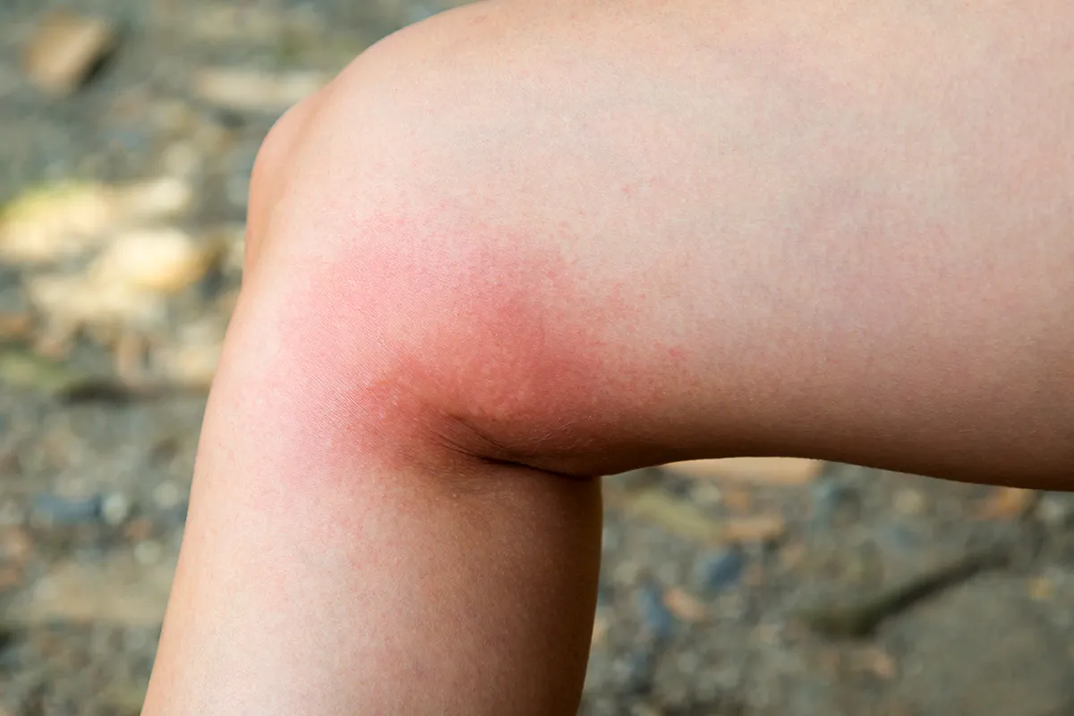 Starke Rötung im äußeren Kniegelenkbereich