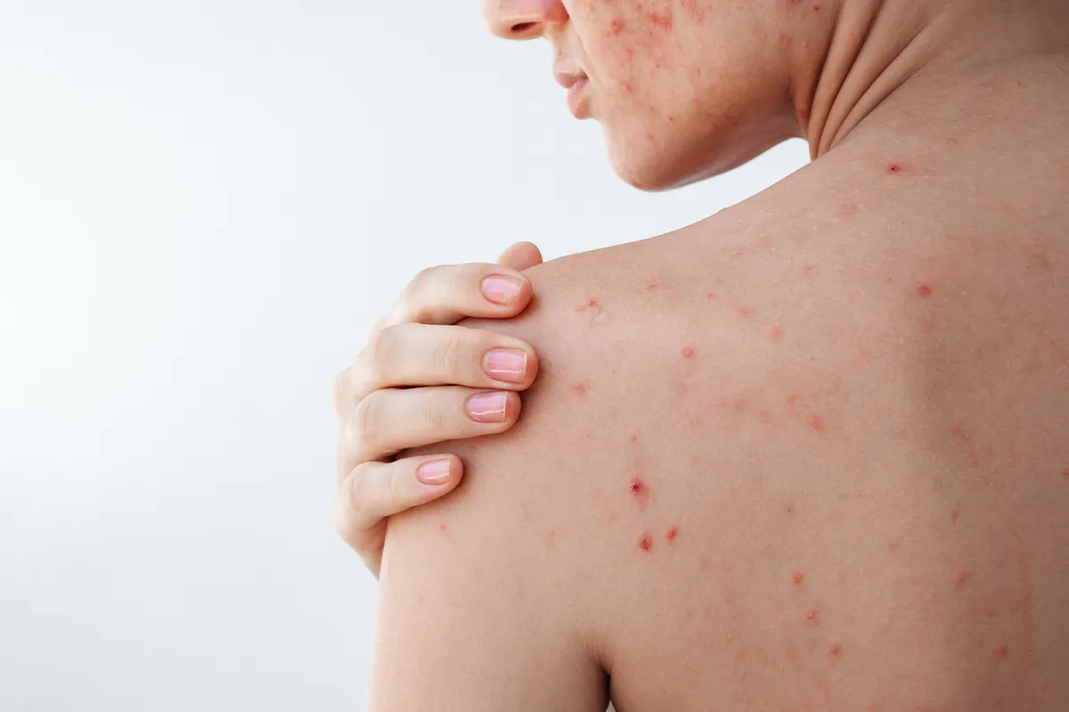 Eine weibliche Person mit vielen rötlichen, teils offenen, Pickeln im Schulterbreich und im Gesicht