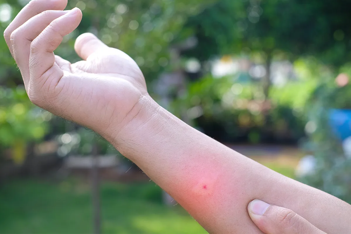 Roter Punkt mit rötung drum herum am Unterarm