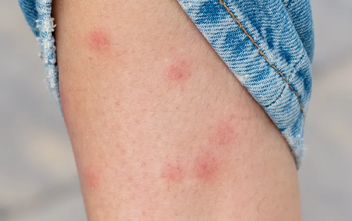 Insektenstich Juckreiz und Entzündungen Eine kleiner Hautteil mit mehreren geröteten Insektenstichen