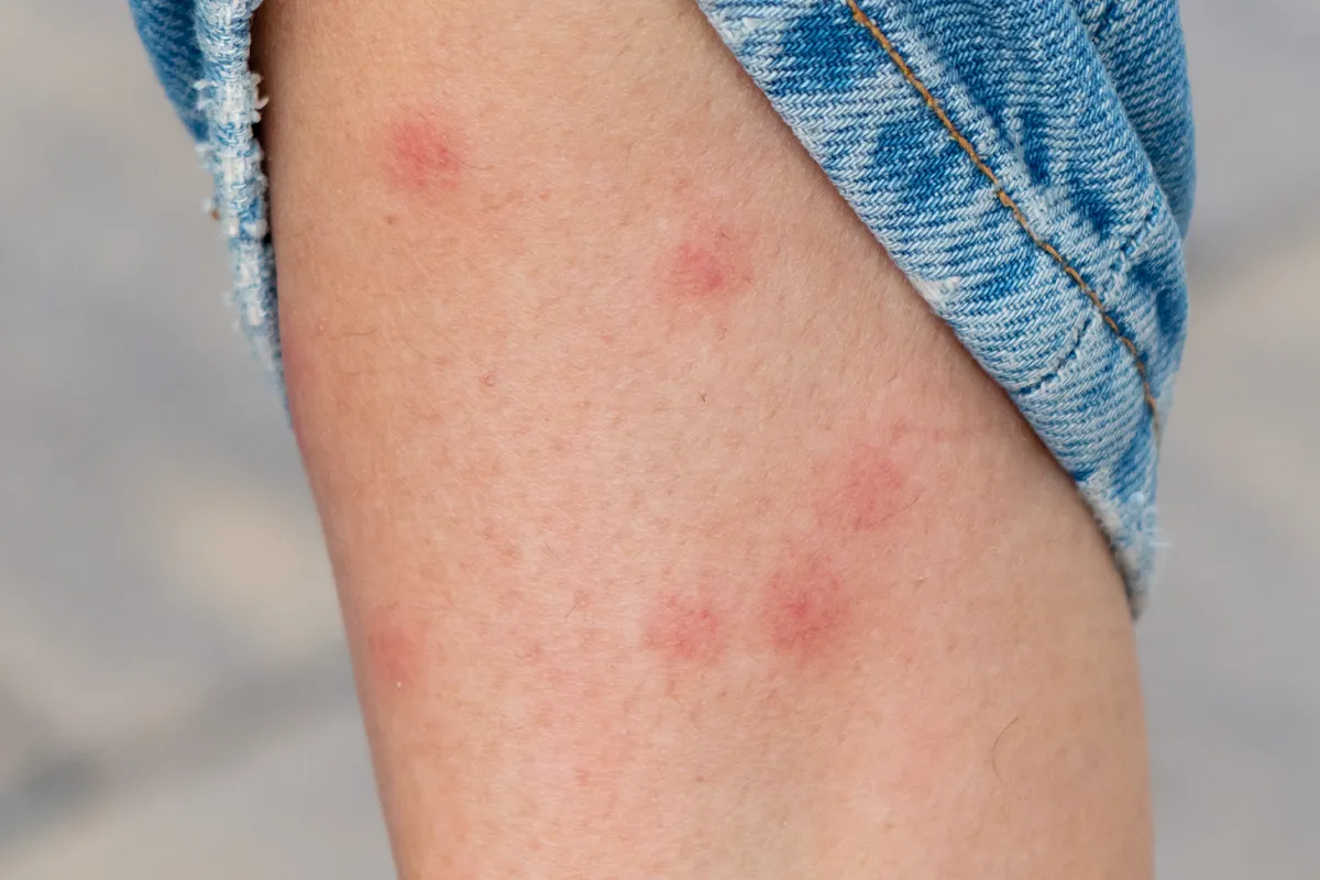 Eine kleiner Hautteil mit mehreren geröteten Insektenstichen