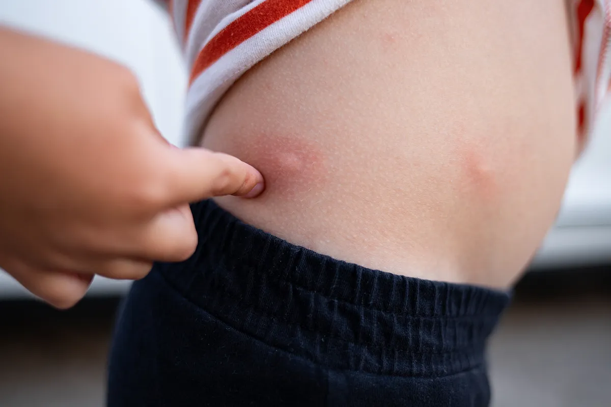 Ein großer geschwollener Insektenstich im Hüftbereich einer Person mit Rötungen drum herum
